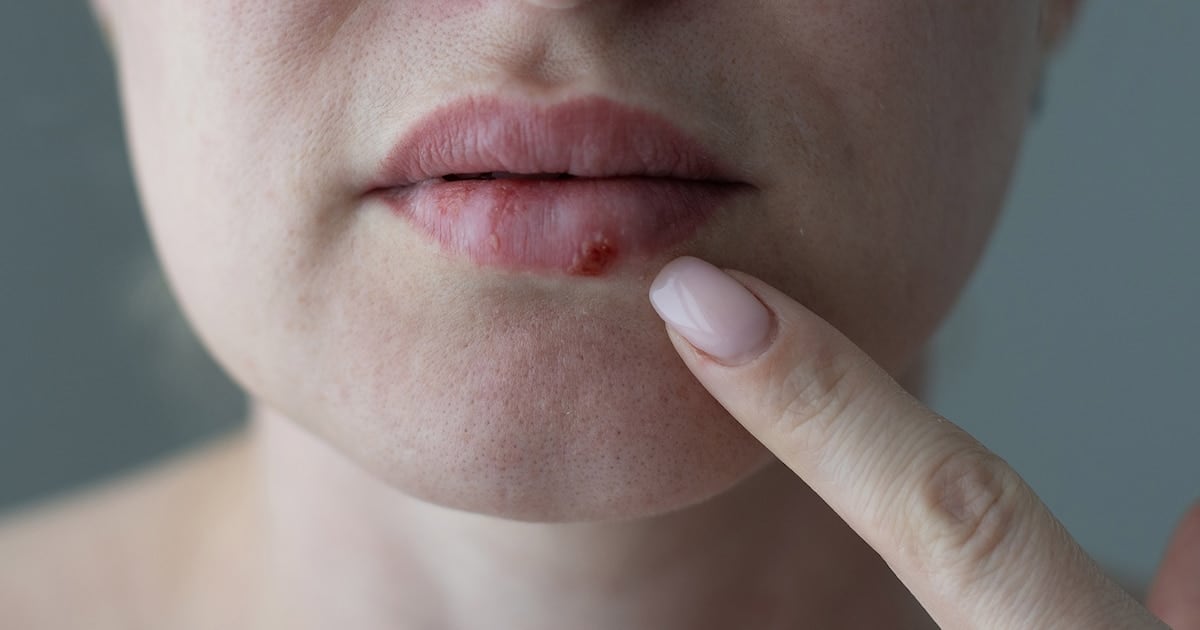 Después de casi treinta años, llega una pastilla que rompe la resistencia del herpes en pacientes inmunocomprometidos
